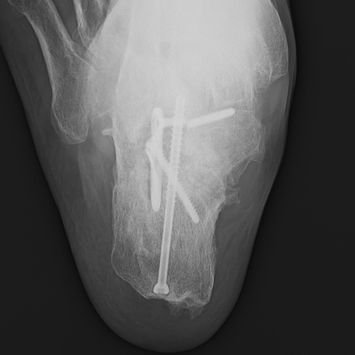 Case 1 AP and Oblique XRays